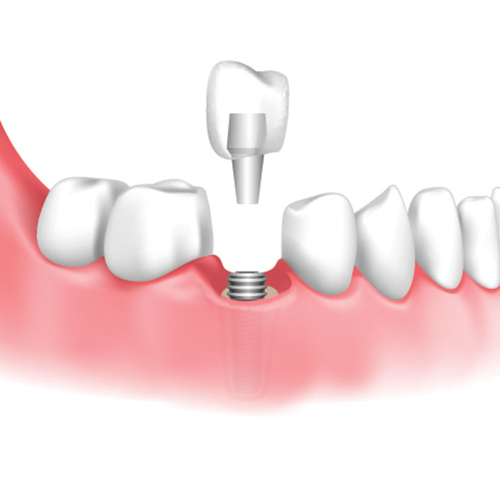 dental cleaning