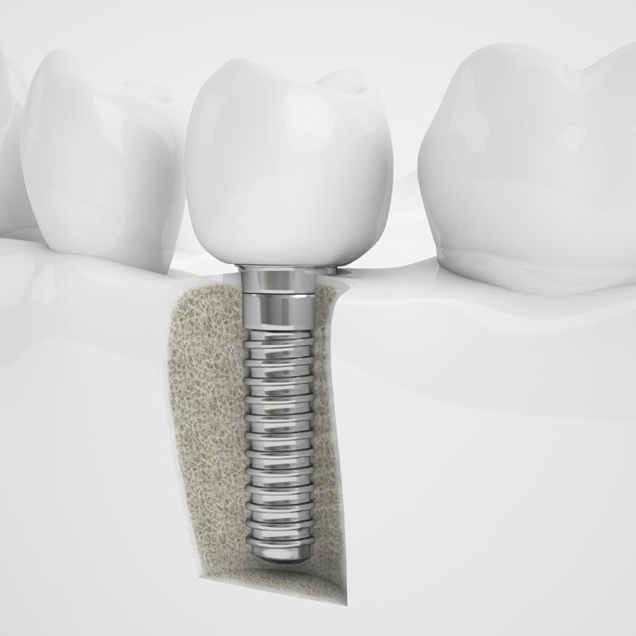 Implant-restoration